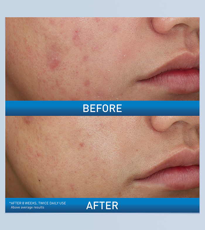 bpo10-cheeks-ba-desktop-700x785-v1.jpg