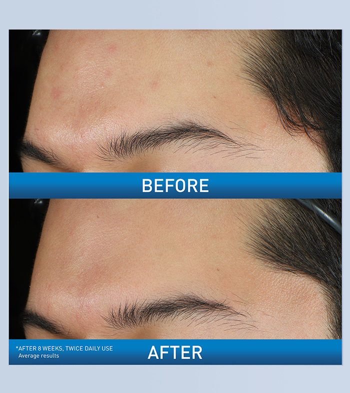 bpo10-forehead-ba-desktop-700x785-v1.jpg